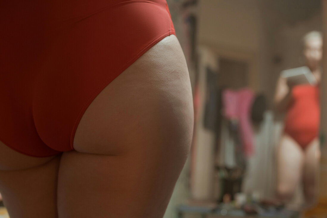 Liposukce hýždí, cvičení, nebo dieta? Co je účinnější a za jakých okolností? Liposukce hýždí, cvičení, nebo dieta? Co je účinnější a za jakých okolností?